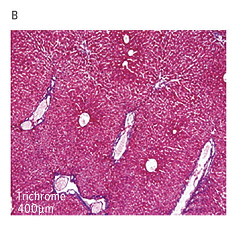Fig B:  This section from a paraffin-embedded liver sample obtained from mdr2–/– mice on DOT 14 was subjected to H&E and trichrome staining. Components of sclerosing cholangitis score (inflammation, ductal proliferation, necrosis, and fibrosis) were analyzed on a 1-41 scale.